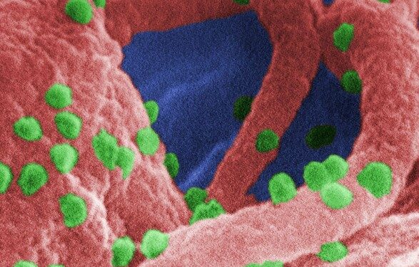 Первая женщина «вылечилась» от ВИЧ благодаря стволовым клеткам — ученые