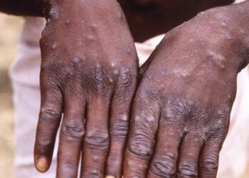 Украина ожидает рекомендации от ВОЗ по противодействию обезьяньей оспе