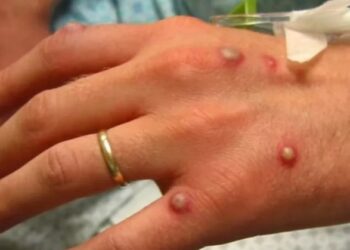 В Грузии зафиксирован первый случай оспы обезьян