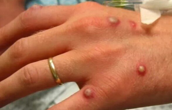 В Грузии зафиксирован первый случай оспы обезьян