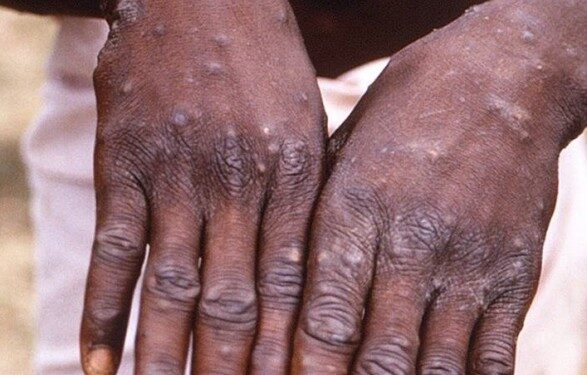 На Европу приходится 85% нынешних случаев обезьяньей оспы — ВОЗ