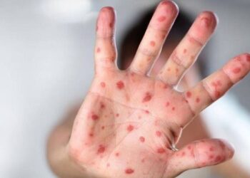 ВОЗ призывает к срочным действиям в Европе в связи с обезьяньей оспой: количество случаев утроилось