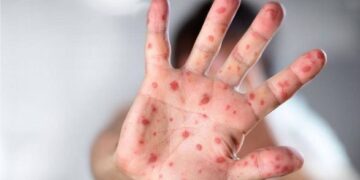 ВОЗ призывает к срочным действиям в Европе в связи с обезьяньей оспой: количество случаев утроилось