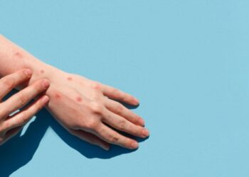 В мире зафиксировано более 50 тысяч больных оспой обезьян – ВОЗ