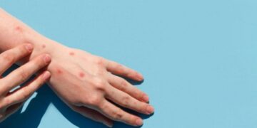 В мире зафиксировано более 50 тысяч больных оспой обезьян – ВОЗ