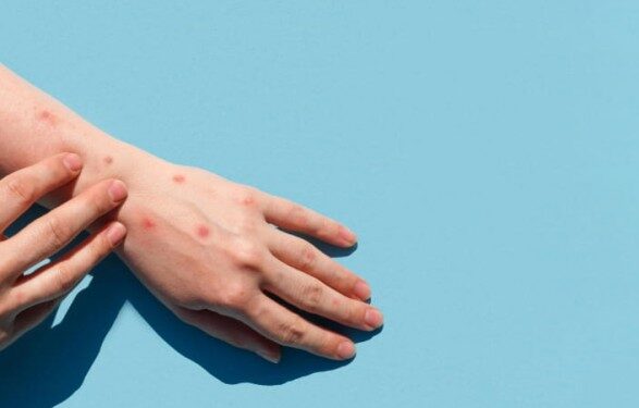 В мире зафиксировано более 50 тысяч больных оспой обезьян – ВОЗ