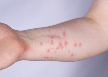 В Украине зафиксировали уже четвертый случай оспы обезьян