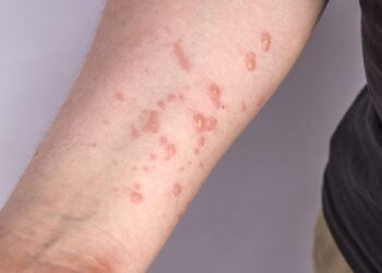 В Украине зафиксирован новый случай оспы обезьян: все пациенты имеют легкое течение заболевания