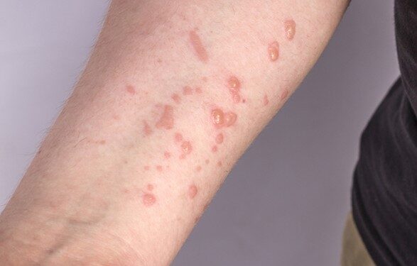 В Украине зафиксирован новый случай оспы обезьян: все пациенты имеют легкое течение заболевания