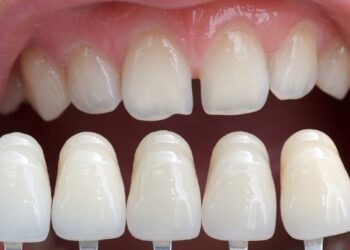 Керамические виниры: для чего они нужны и какой уход им необходим | Одеський Монітор