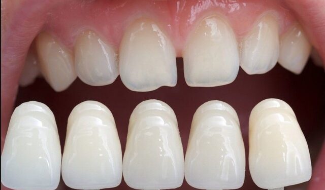 Керамические виниры: для чего они нужны и какой уход им необходим | Одеський Монітор