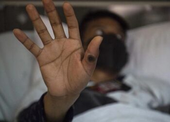 Эксперты назвали четыре возможных сценария развития вспышки оспы обезьян