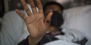 Эксперты назвали четыре возможных сценария развития вспышки оспы обезьян