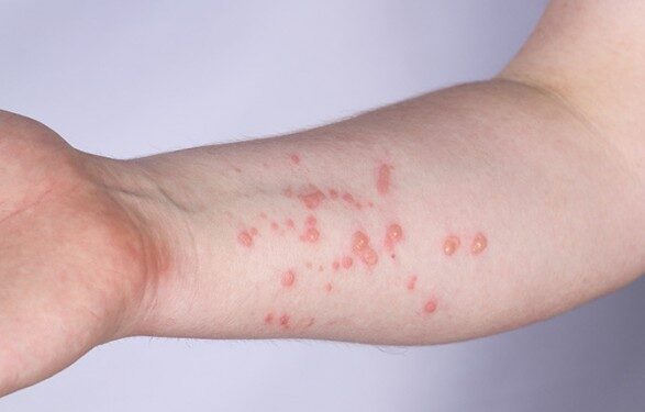 Новых случаев обезьяньей оспы в Украине не фиксировали