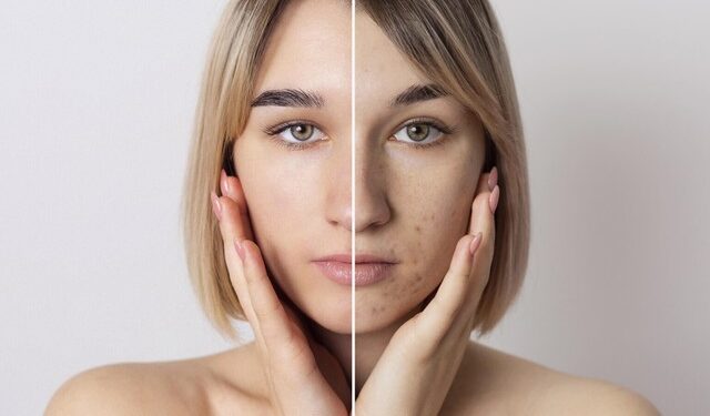 Что такое постакне и как от него избавиться | Одеський Монітор