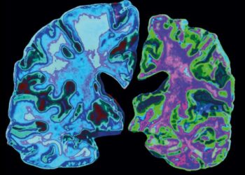 В США одобрили новый препарат для лечения болезни Альцгеймера