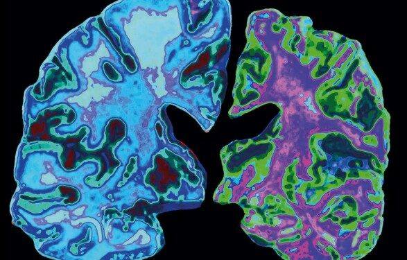 В США одобрили новый препарат для лечения болезни Альцгеймера