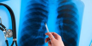 Развитие туберкулеза потенциально могут провоцировать стресс и условия во время войны — ЦОЗ
