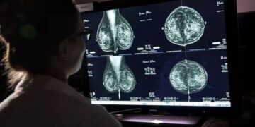 Группа здоровья США рекомендует женщинам проходить маммографию уже с 40 лет