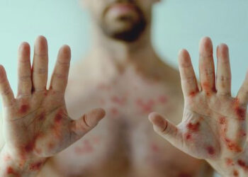 ВОЗ отменила режим чрезвычайной ситуации в мире из-за оспы обезьян