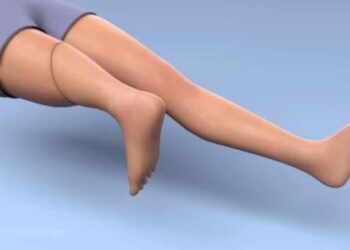 Во Львове врачи пришили девушке ногу задом наперед