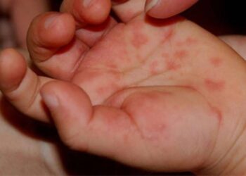 На Одещині фіксують летальні випадки менінгіту