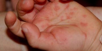 На Одещині фіксують летальні випадки менінгіту