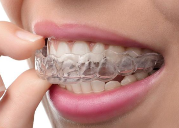 Что такое элайнеры и их преимущества