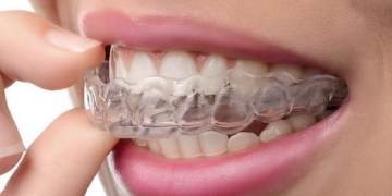 Что такое элайнеры и их преимущества